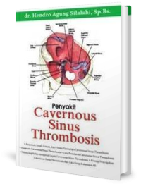 Image of Penyakit Carvernous Sinus Thrombosis